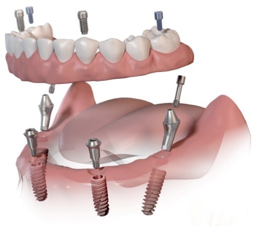 Partial Dentures Before And After Rocky Mount MO 65072